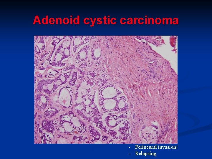 Adenoid cystic carcinoma - Perineural invasion! - Relapsing Adenoid cystic carcinoma - Perineural invasion! - Relapsing