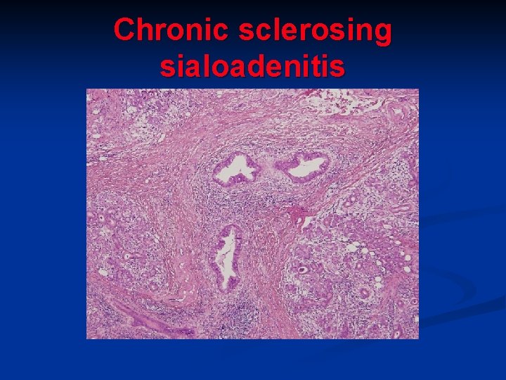 Chronic sclerosing sialoadenitis Chronic sclerosing sialoadenitis
