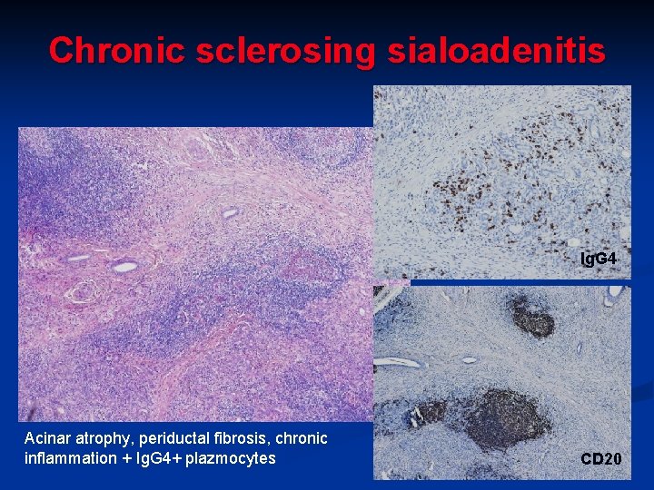 Chronic sclerosing sialoadenitis Ig. G 4 Acinar atrophy, periductal fibrosis, chronic inflammation + Ig. Chronic sclerosing sialoadenitis Ig. G 4 Acinar atrophy, periductal fibrosis, chronic inflammation + Ig.