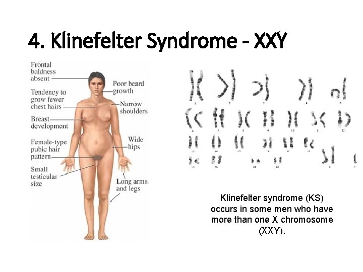 4. Klinefelter Syndrome - XXY Klinefelter syndrome (KS) occurs in some men who have