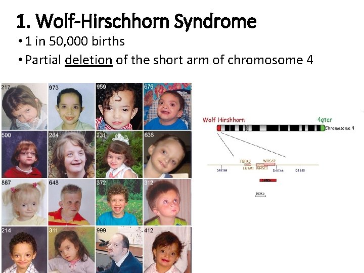 1. Wolf-Hirschhorn Syndrome • 1 in 50, 000 births • Partial deletion of the