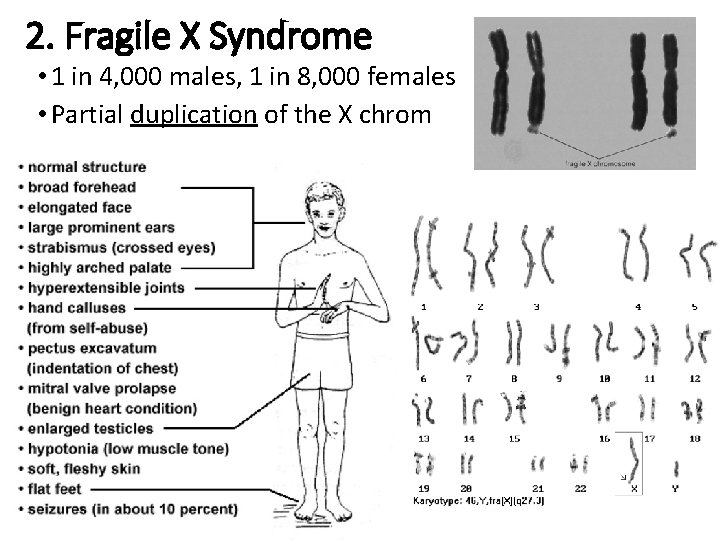 2. Fragile X Syndrome • 1 in 4, 000 males, 1 in 8, 000