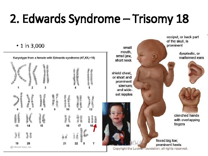 2. Edwards Syndrome – Trisomy 18 • 1 in 3, 000 