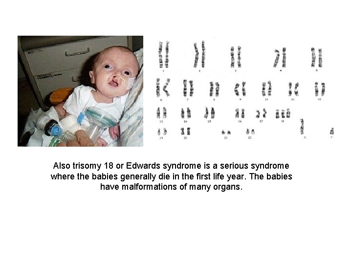 Also trisomy 18 or Edwards syndrome is a serious syndrome where the babies generally