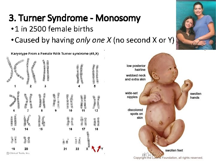 3. Turner Syndrome - Monosomy • 1 in 2500 female births • Caused by
