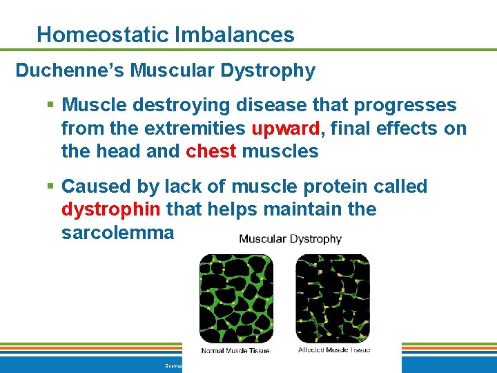 Homeostatic Imbalances Duchenne’s Muscular Dystrophy § Muscle destroying disease that progresses from the extremities