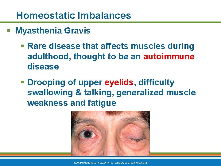 Homeostatic Imbalances § Myasthenia Gravis § Rare disease that affects muscles during adulthood, thought