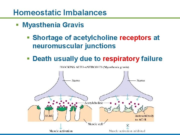 Homeostatic Imbalances § Myasthenia Gravis § Shortage of acetylcholine receptors at neuromuscular junctions §