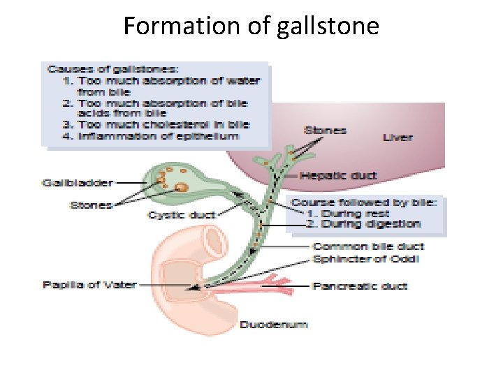 Formation of gallstone 