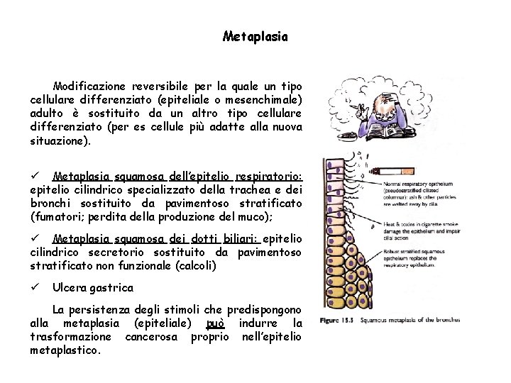 Metaplasia Modificazione reversibile per la quale un tipo cellulare differenziato (epiteliale o mesenchimale) adulto