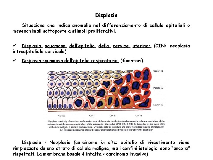 Displasia Situazione che indica anomalie nel differenziamento di cellule epiteliali o mesenchimali sottoposte a