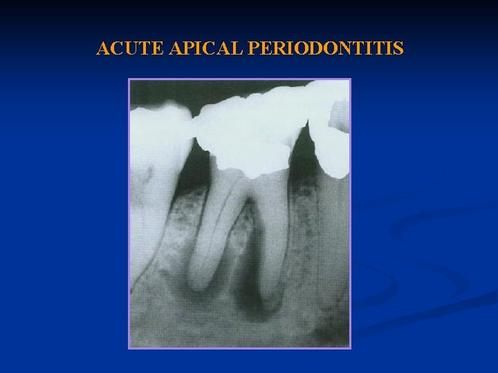 ACUTE APICAL PERIODONTITIS 