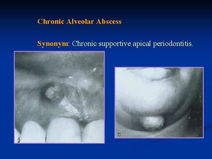 Chronic Alveolar Abscess Synonym: Chronic supportive apical periodontitis. 