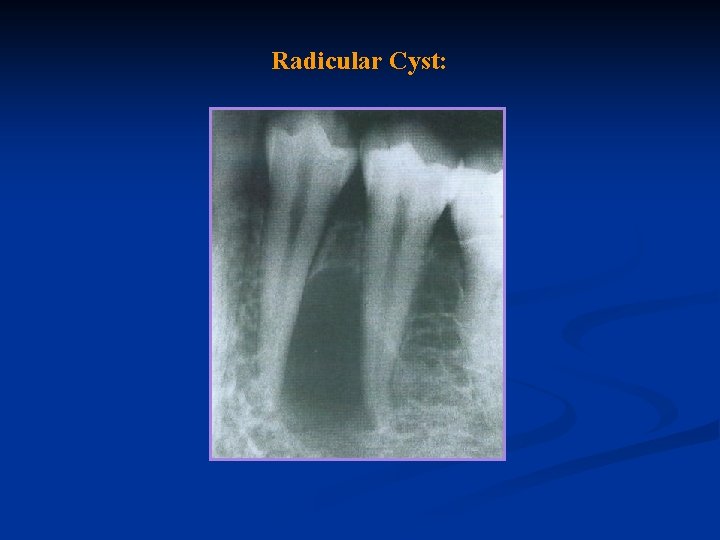 Radicular Cyst: 