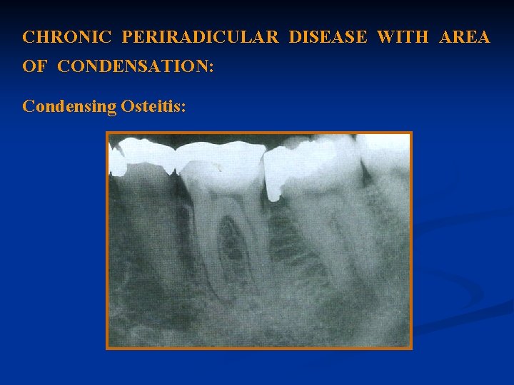 CHRONIC PERIRADICULAR DISEASE WITH AREA OF CONDENSATION: Condensing Osteitis: 