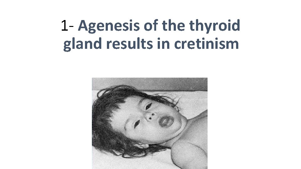 1 - Agenesis of the thyroid gland results in cretinism 