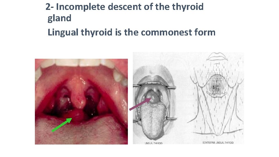 2 - Incomplete descent of the thyroid gland Lingual thyroid is the commonest form