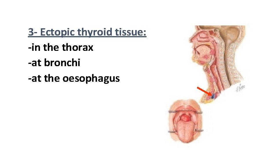 3 - Ectopic thyroid tissue: -in the thorax -at bronchi -at the oesophagus 