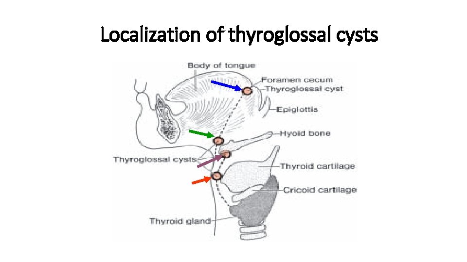 Localization of thyroglossal cysts 