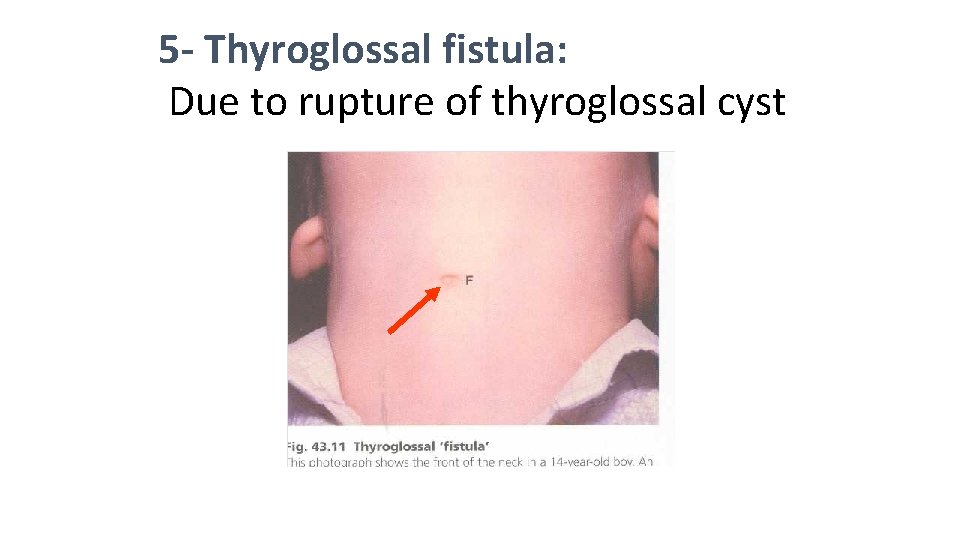 5 - Thyroglossal fistula: Due to rupture of thyroglossal cyst 