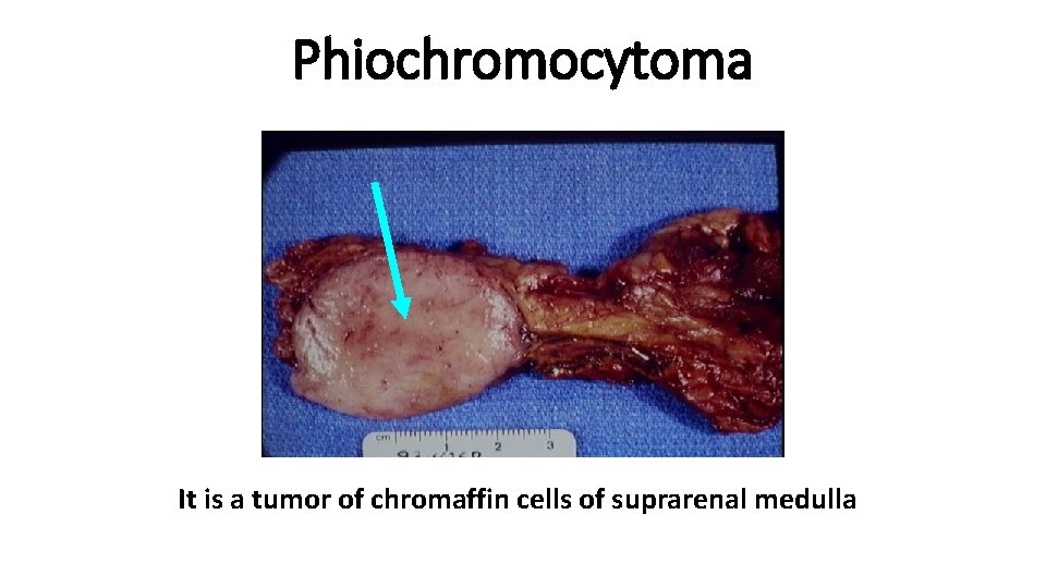 Phiochromocytoma It is a tumor of chromaffin cells of suprarenal medulla 