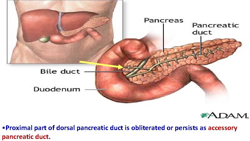  • Proximal part of dorsal pancreatic duct is obliterated or persists as accessory