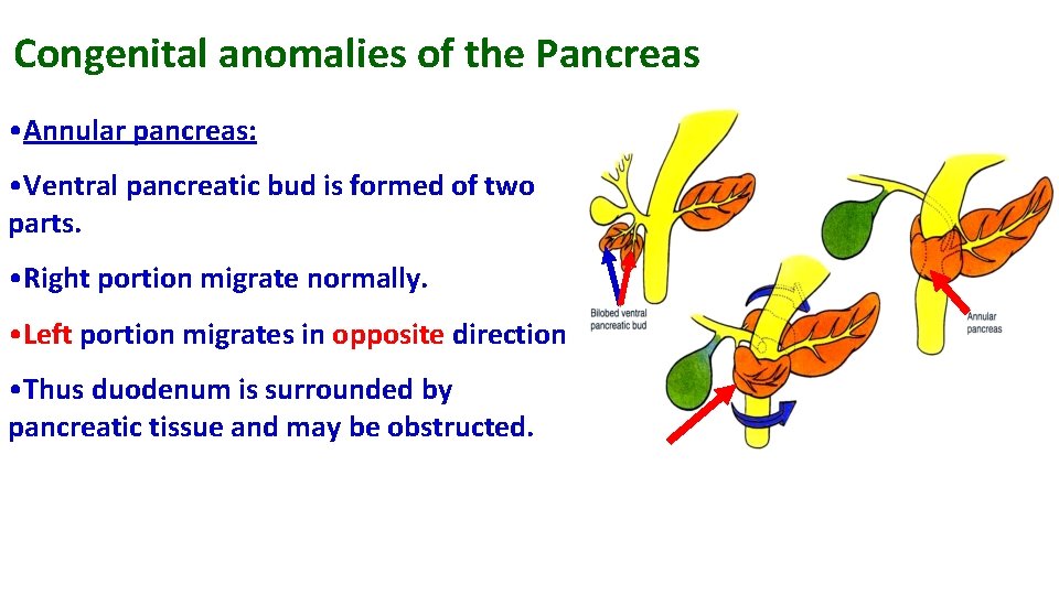 Congenital anomalies of the Pancreas • Annular pancreas: • Ventral pancreatic bud is formed