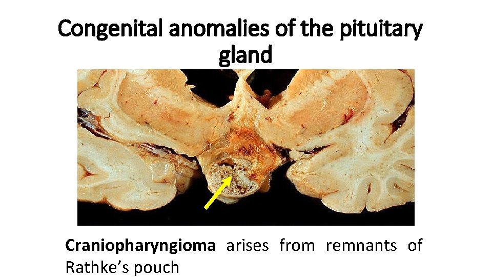 Congenital anomalies of the pituitary gland Craniopharyngioma arises from remnants of Rathke’s pouch 