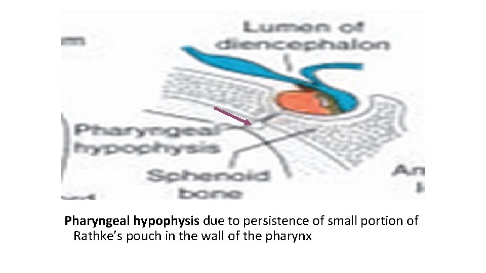 Pharyngeal hypophysis due to persistence of small portion of Rathke’s pouch in the wall