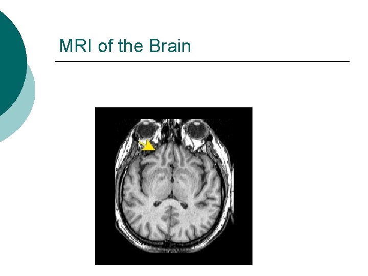 MRI of the Brain MRI of the Brain