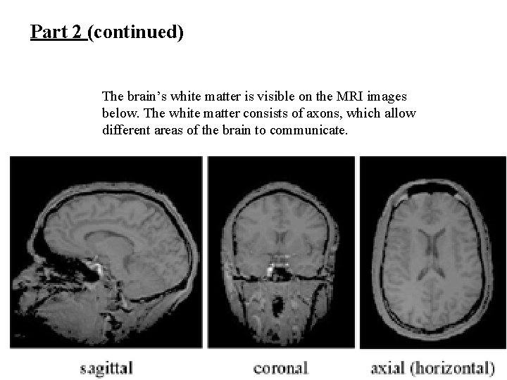 Part 2 (continued) The brain’s white matter is visible on the MRI images below.