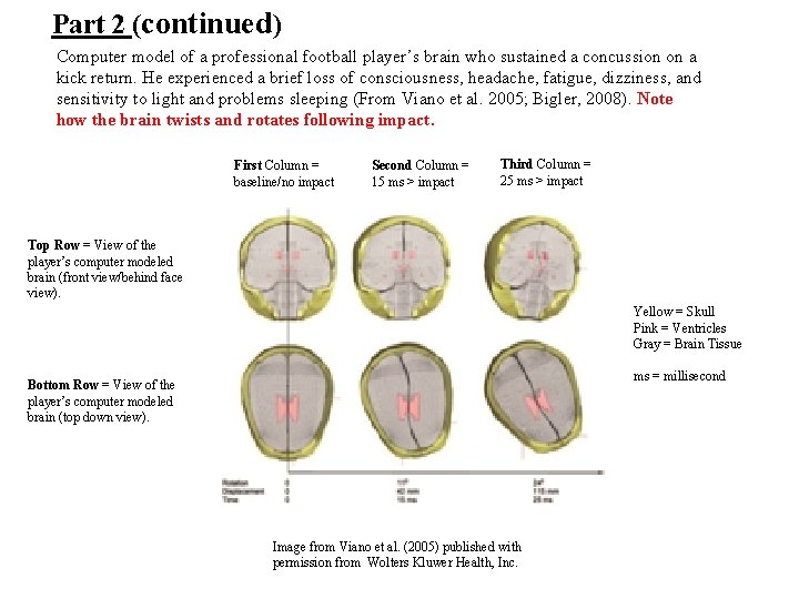 Part 2 (continued) Computer model of a professional football player’s brain who sustained a