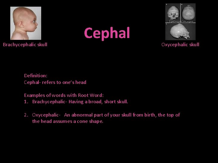 Brachycephalic skull Cephal Oxycephalic skull Definition: Cephal- refers to one’s head Examples of words