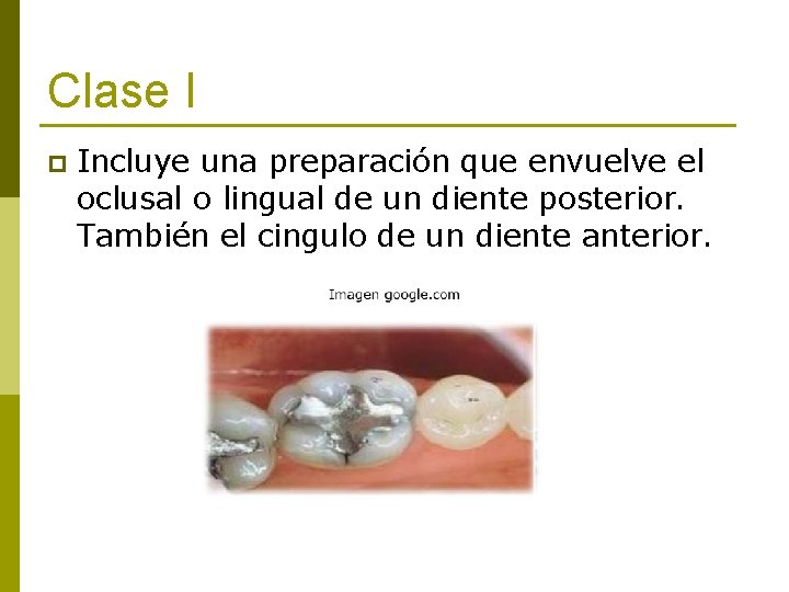 Clase I p Incluye una preparación que envuelve el oclusal o lingual de un