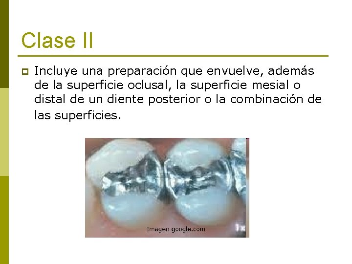 Clase II p Incluye una preparación que envuelve, además de la superficie oclusal, la