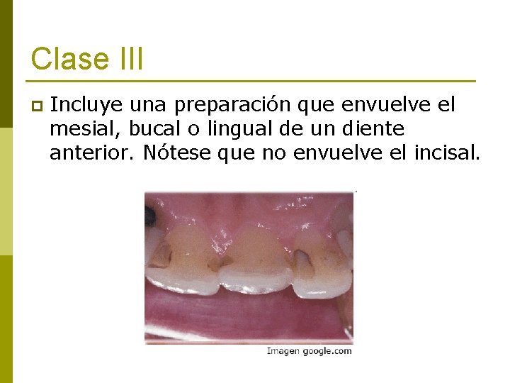 Clase III p Incluye una preparación que envuelve el mesial, bucal o lingual de