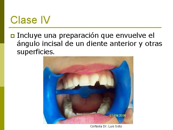 Clase IV p Incluye una preparación que envuelve el ángulo incisal de un diente