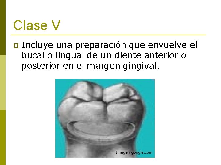Clase V p Incluye una preparación que envuelve el bucal o lingual de un