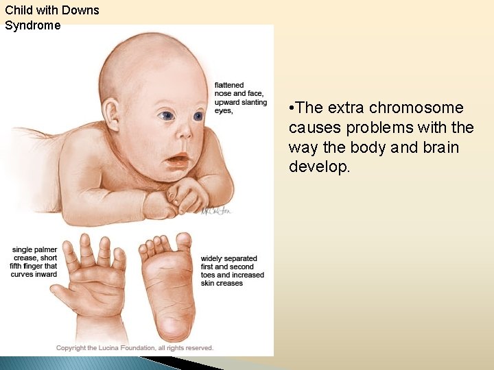 Child with Downs Syndrome • The extra chromosome causes problems with the way the