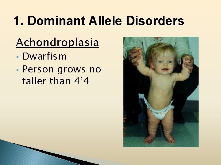 1. Dominant Allele Disorders Achondroplasia § § Dwarfism Person grows no taller than 4’