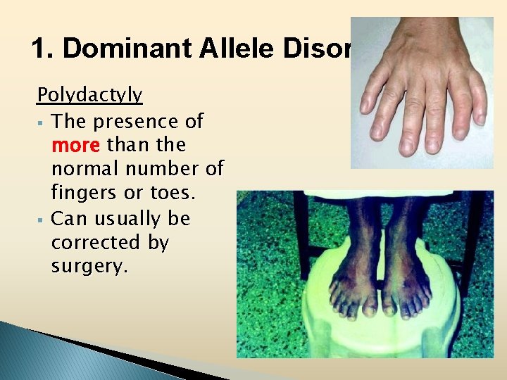 1. Dominant Allele Disorders Polydactyly § The presence of more than the normal number