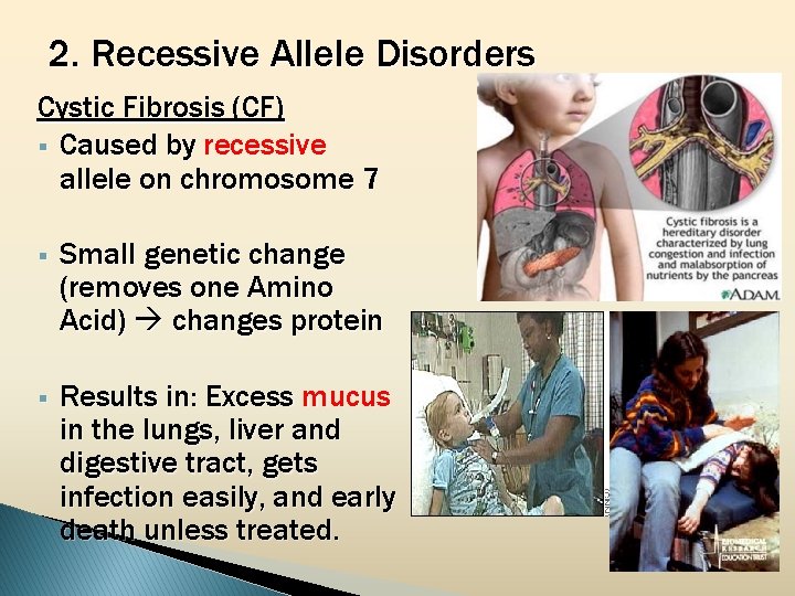 2. Recessive Allele Disorders Cystic Fibrosis (CF) § Caused by recessive allele on chromosome