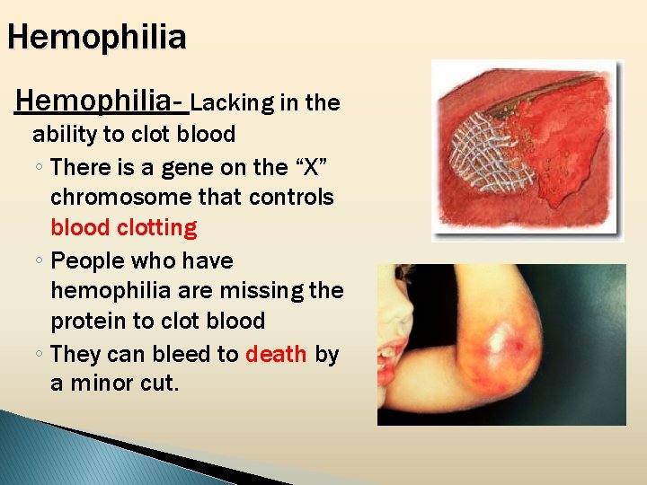 Hemophilia- Lacking in the ability to clot blood ◦ There is a gene on
