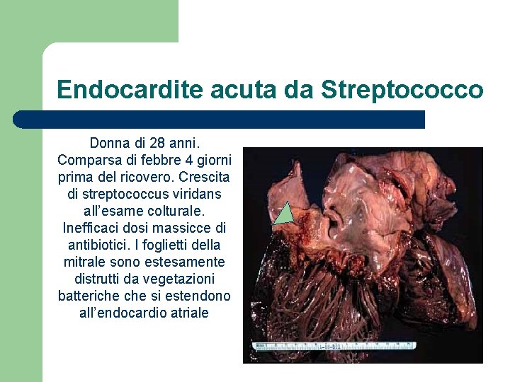 Endocardite acuta da Streptococco Donna di 28 anni. Comparsa di febbre 4 giorni prima