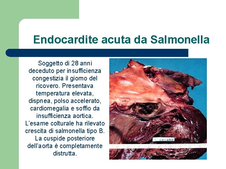Endocardite acuta da Salmonella Soggetto di 28 anni deceduto per insufficienza congestizia il giorno