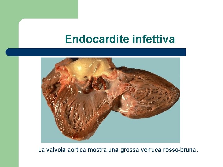 Endocardite infettiva La valvola aortica mostra una grossa verruca rosso-bruna. 