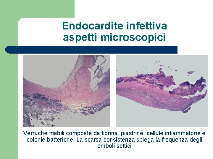 Endocardite infettiva aspetti microscopici Verruche friabili composte da fibrina, piastrine, cellule infiammatorie e colonie