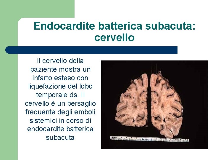 Endocardite batterica subacuta: cervello Il cervello della paziente mostra un infarto esteso con liquefazione