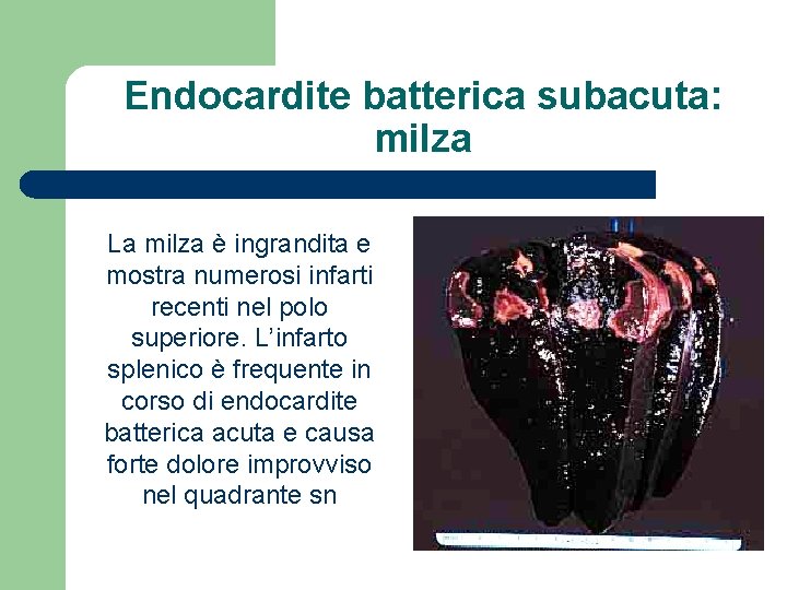 Endocardite batterica subacuta: milza La milza è ingrandita e mostra numerosi infarti recenti nel