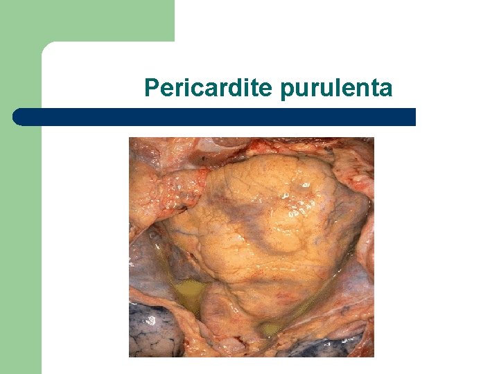 Pericardite purulenta 